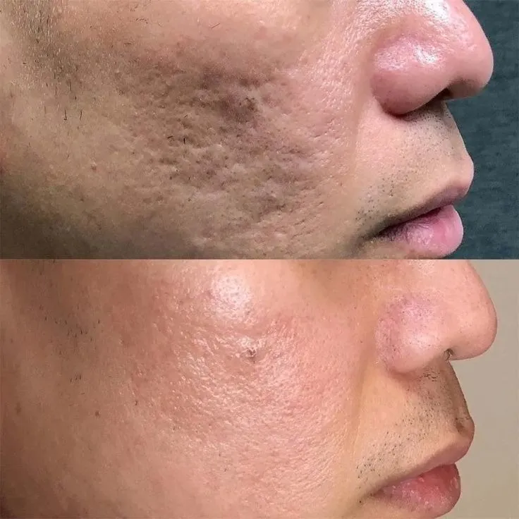 Facial Scars Treatment in Dhule | Gindodia Hospital