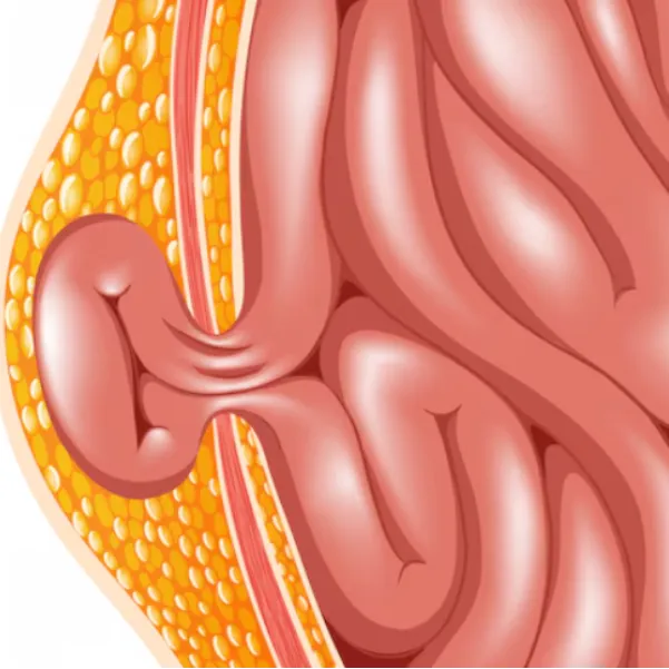 Laparoscopic Hernia Repair in Thane – Stronger Recovery with Minimal Discomfort