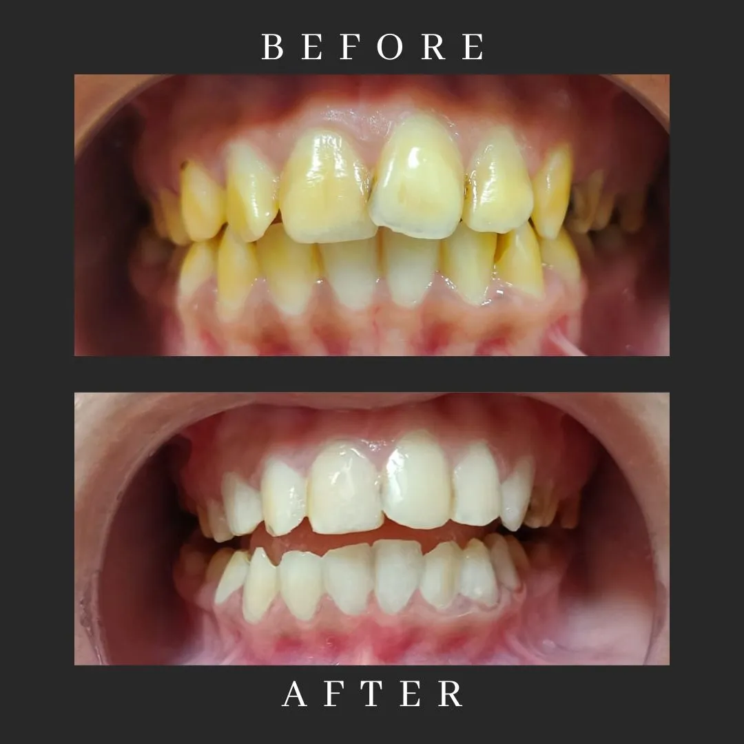 Wedding-Ready Smile: Teeth Whitening Tips for Brides & Grooms in Thane