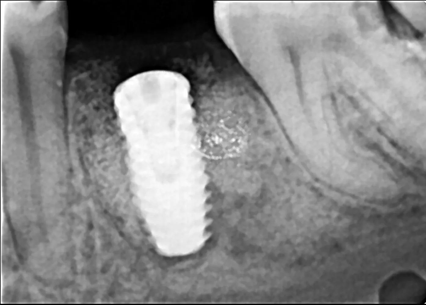 Bone Grafting for Implants – When Is It Needed?
