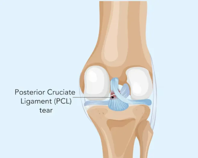 PCL Reconstruction in KR Puram – Knee and Sports Surgery