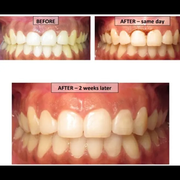 Best Gingivectomy Treatment In Ghansoli