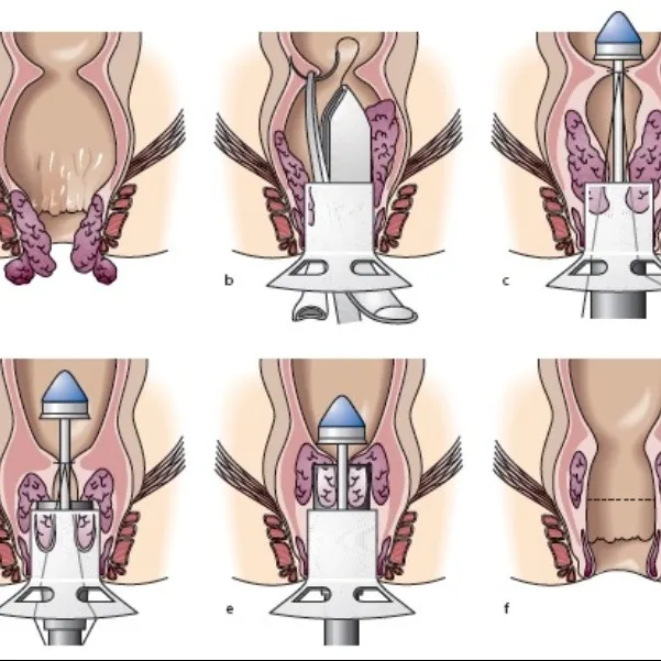 Stapled Hemorrhoidopexy (PPH / Stapled Hemorrhoidectomy)