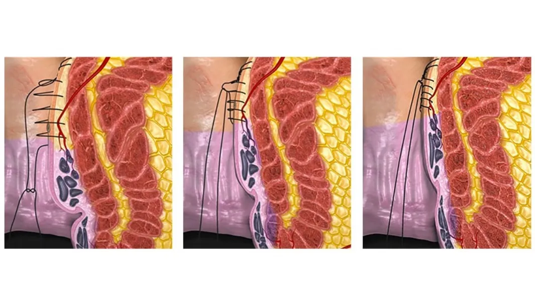 Transanal Hemorrhoidal Dearterialization (THD)