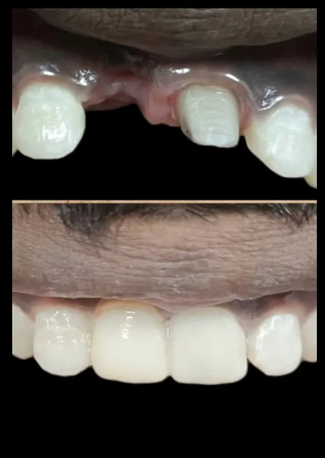 Front Tooth Crown in Mumbai – Aesthetic Considerations