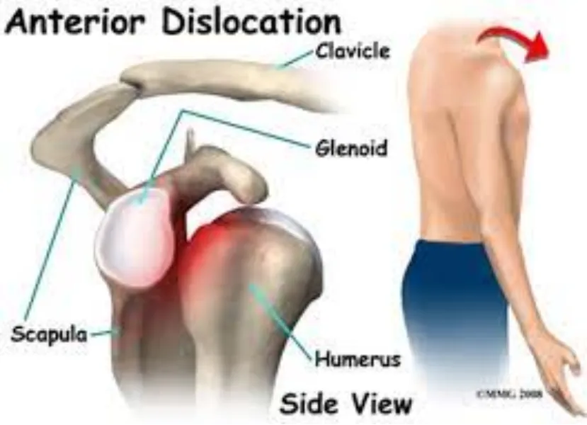 Shoulder Dislocation and Instability in Nagpur – Restoring Stability and Confidence