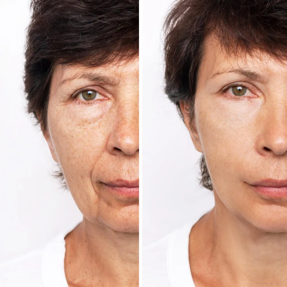 Skin Rejuvenation in Nashik | Younger looking, fresher feeling skin