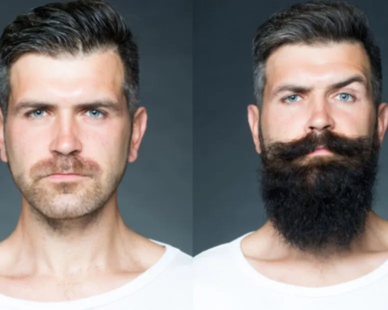 Beard Transplantation in Bangalore – Define Facial Structure Naturally