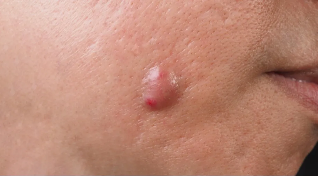 Lipoma and Sebaceous Cyst Treatment in Kolathur, Chennai – When small lumps cause big concern