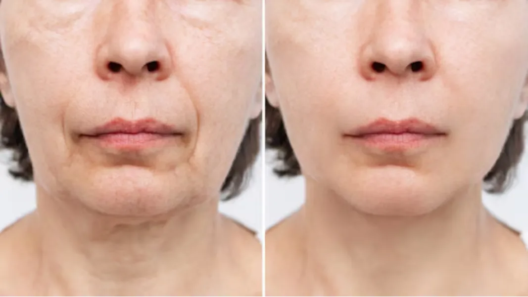 Skin Tightening in Nashik | Firm, lifted and confident skin