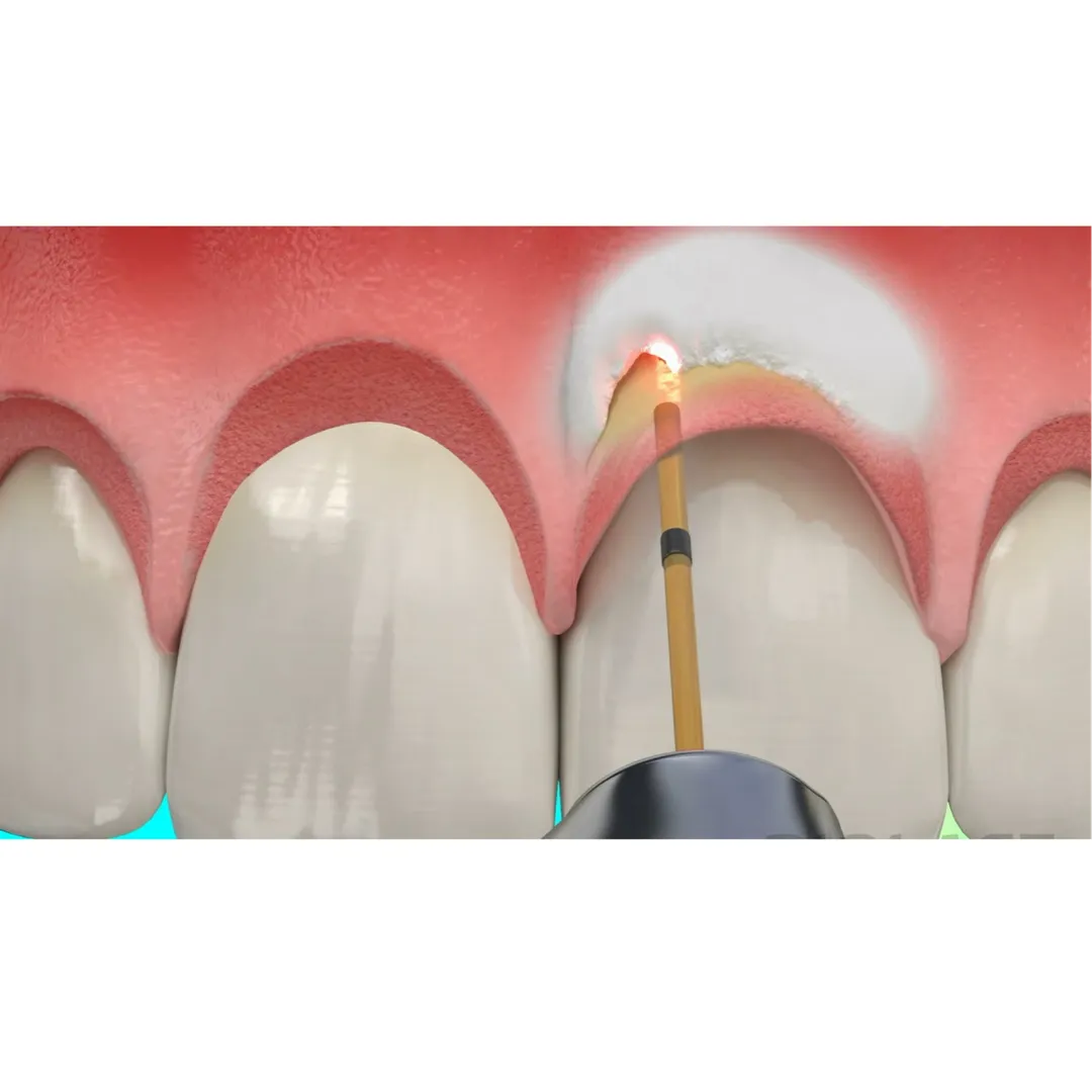 Crown Lengthning with Laser