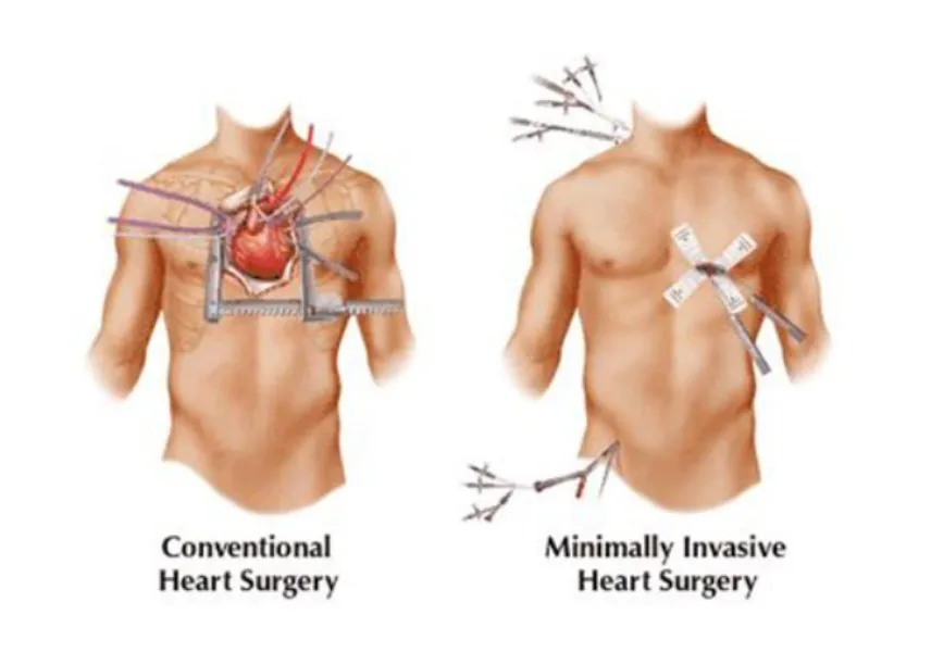 MICS CABG in Nagpur for Minimally Invasive Heart Bypass
