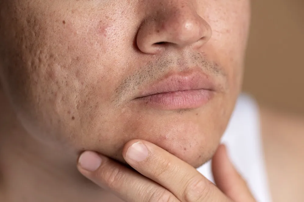 Acne Scar Removal Clinic in Nungambakkam – Clearer Skin with Expert Guidance