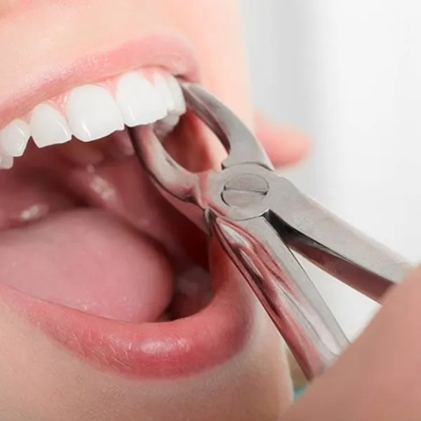 Best tooth extraction in vashi