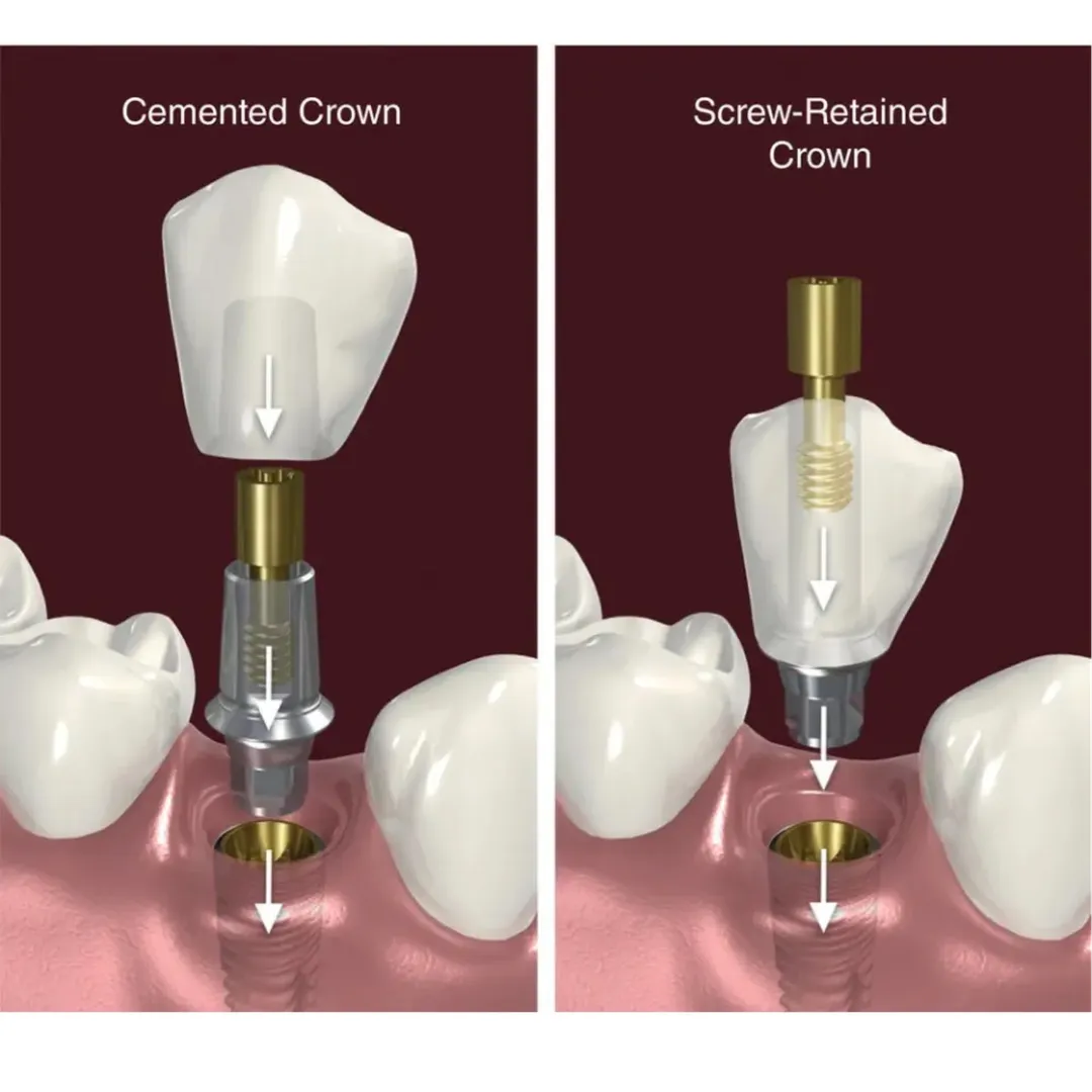 Screw Retained Implants vs Cement Retained Implants