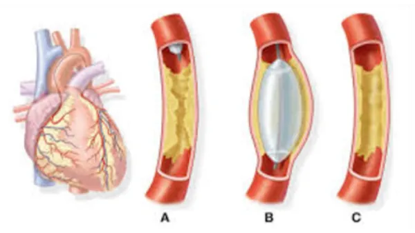 Angiography in Pune - precise cardiac diagnosis