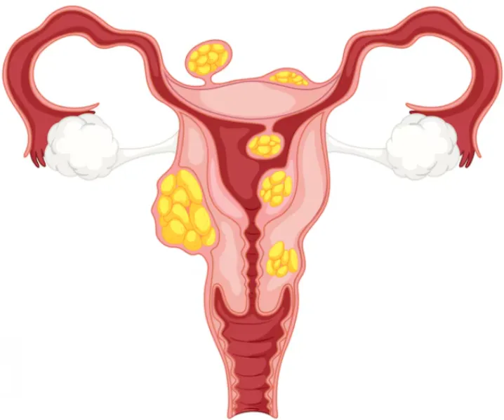 Fibroids Treatment in Nashik for symptom relief and comfort