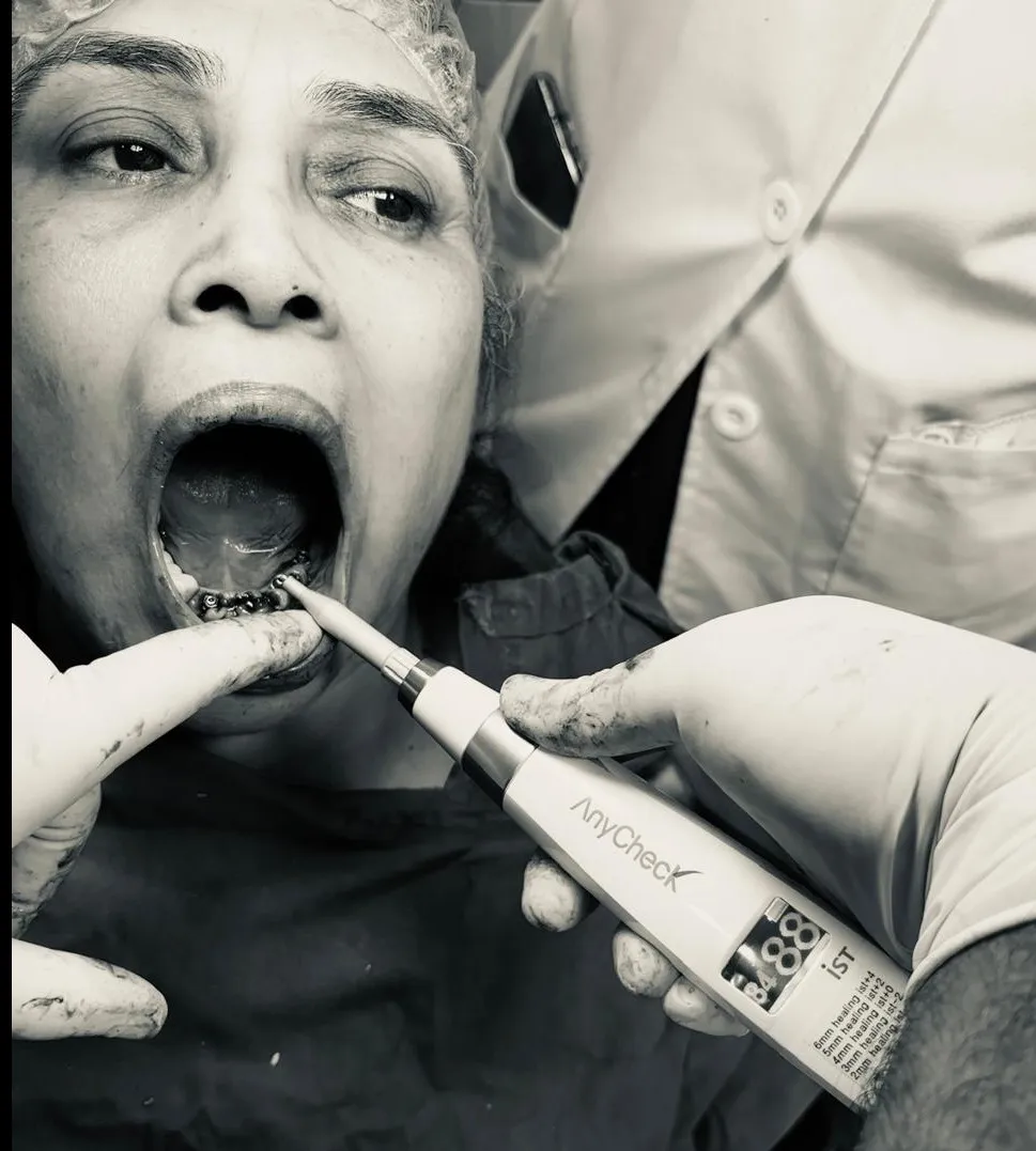 Immediate Implants After Extraction – Pros and Cons