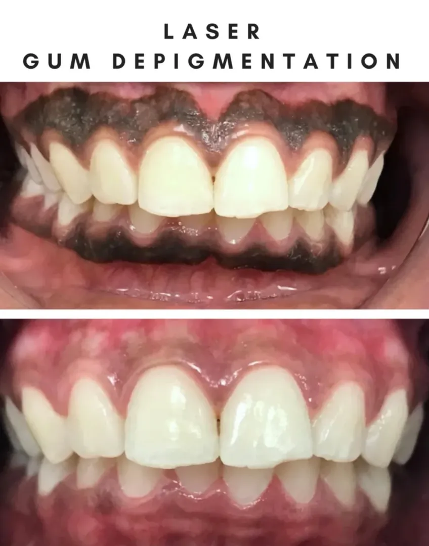 Laser Depigmentation of Gingiva