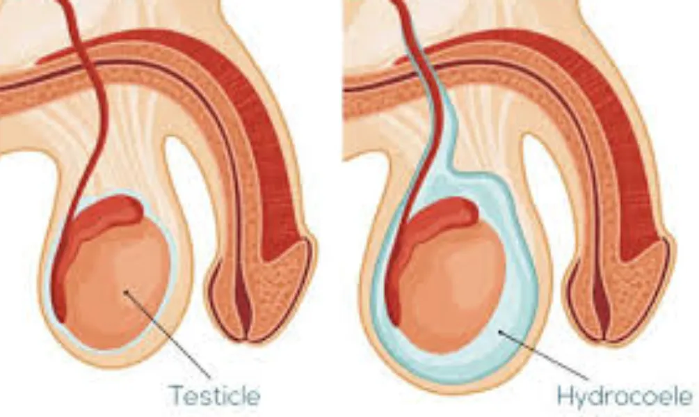 Surgery for Hydrocele in Goregaon: Quick Recovery and Less Discomfort