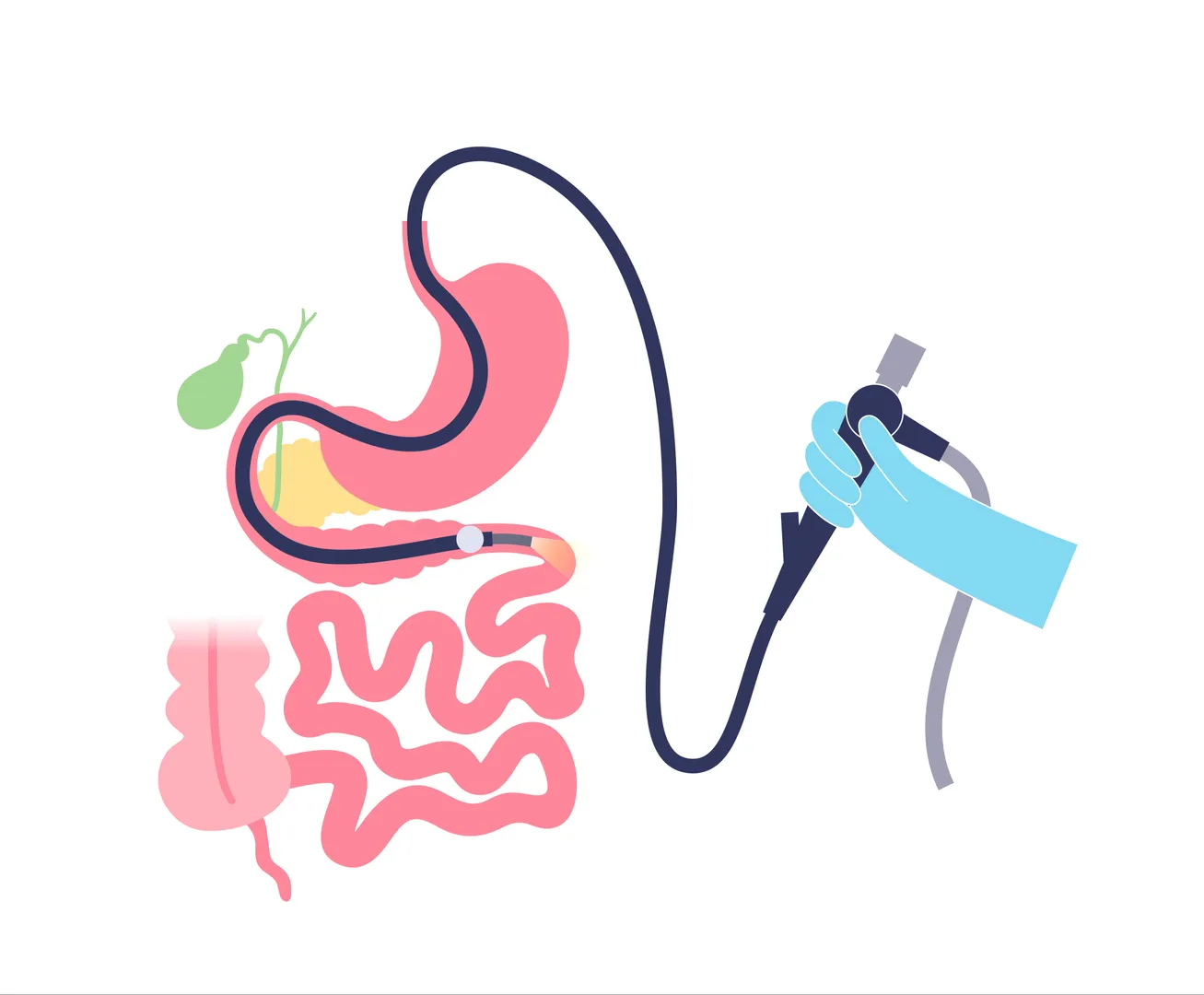 Double Balloon Enteroscopy in Mumbai | Advanced Small Bowel Evaluation