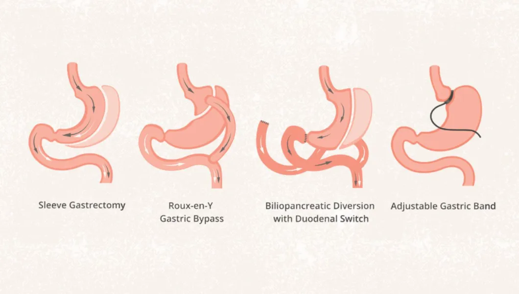 Bariatric (Weight Loss) Surgery in Thane | A scientific path to sustained weight loss