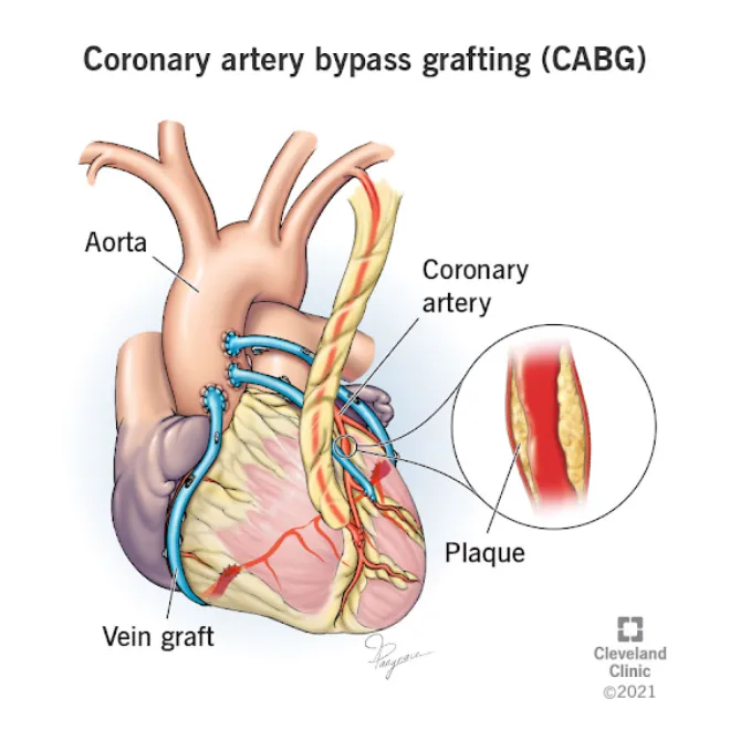 Coronary bypass surgery in Pune - comprehensive heart care support