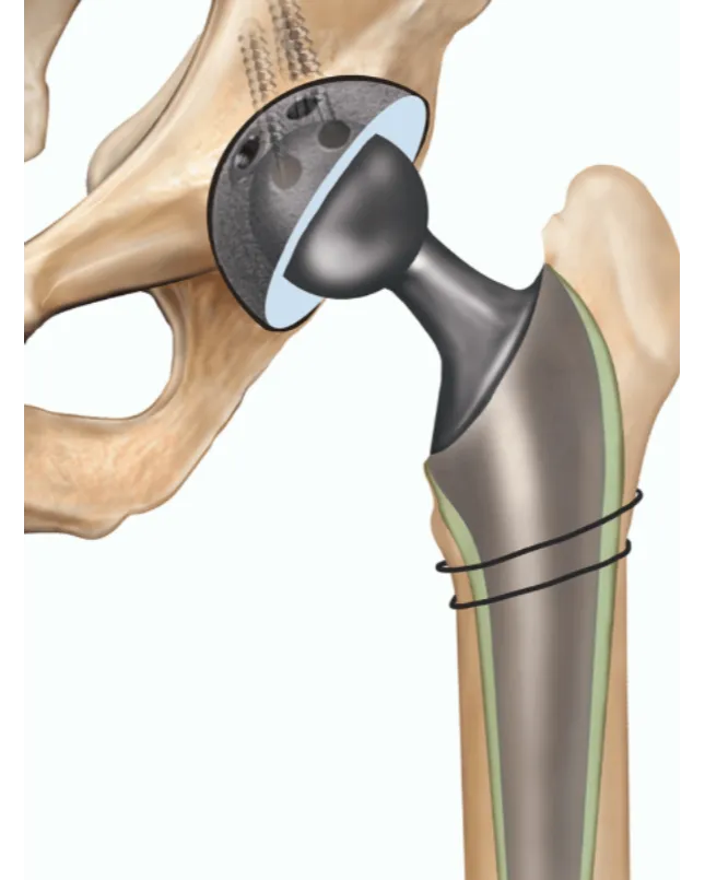 Hip Replacement in Nagpur – A Life Free from Hip Pain