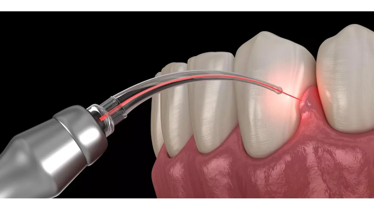Laser Gum Treatment in Madhura Nagar Offering a Gentler Approach to Gum Care