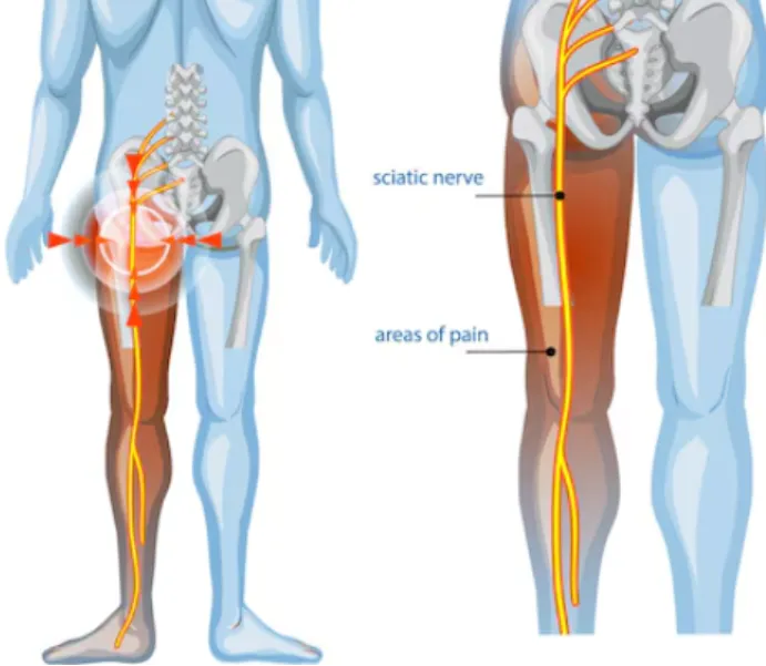Sciatica Treatment in Noida Supporting Comfortable Nerve Movement