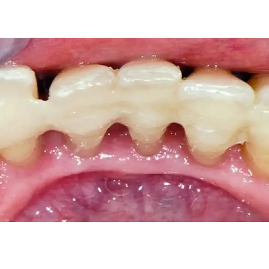 Splinting of Periodontally weak teeth