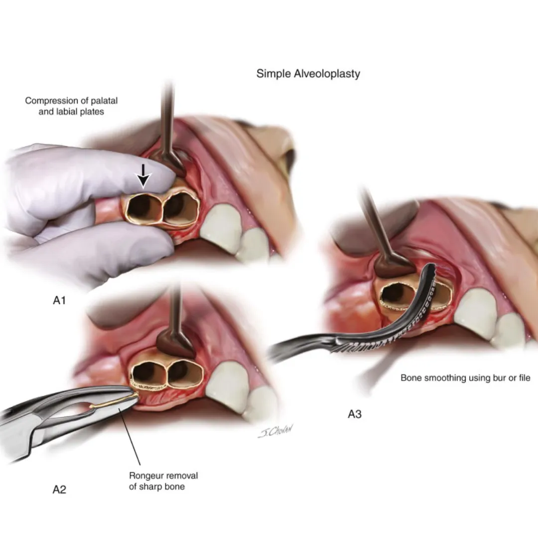 Alveoloplasty