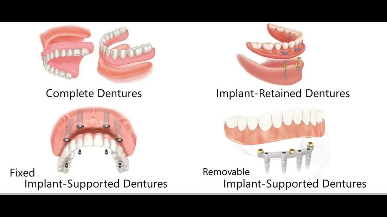 Fixed and Removable Dentures in Madhura Nagar Designed for Everyday Comfort