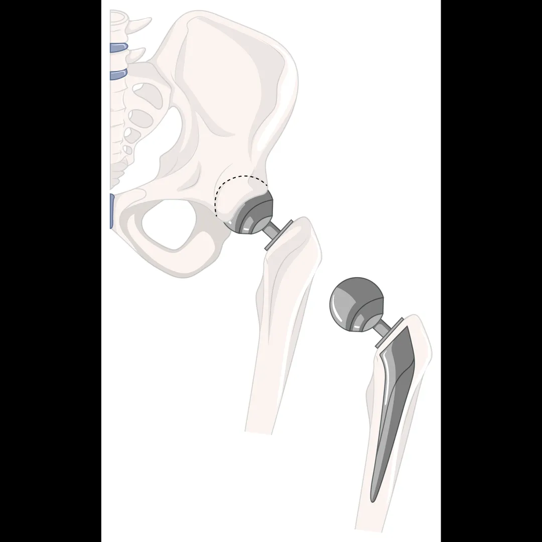 Revision Hip Replacement in Bangalore – Restoring Stability and Function