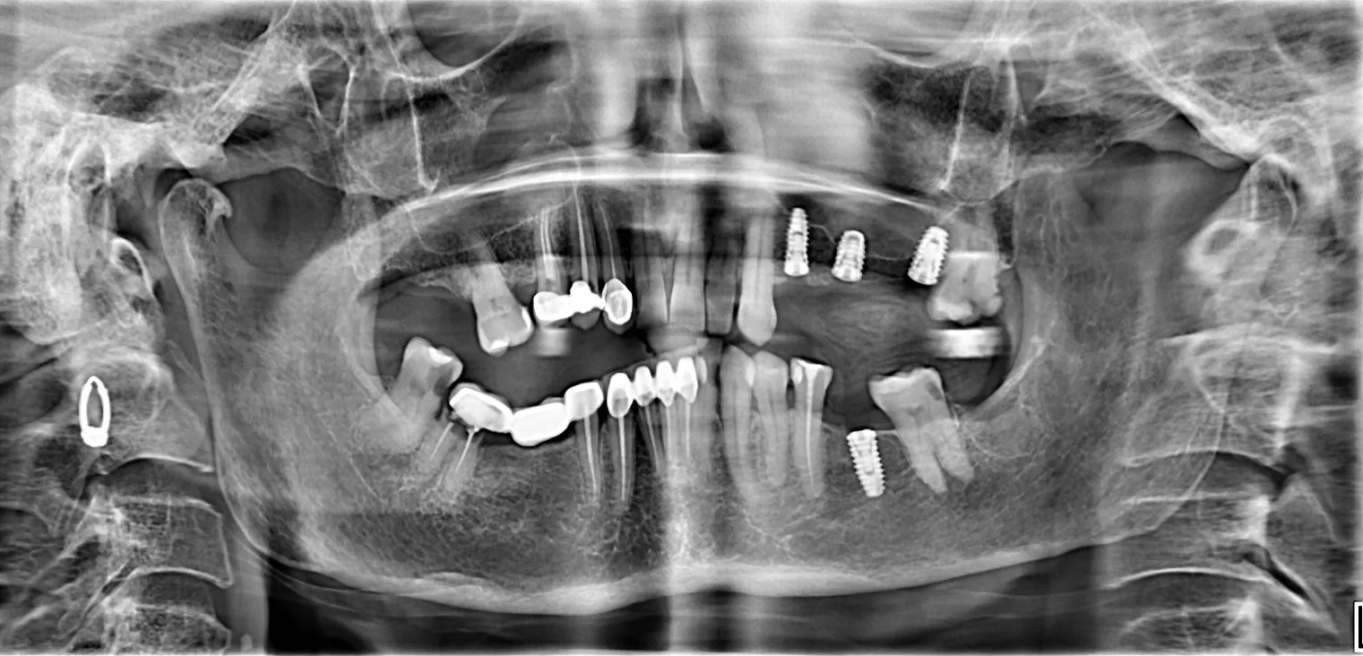 Implants for Back Teeth – Do You Really Need Them?