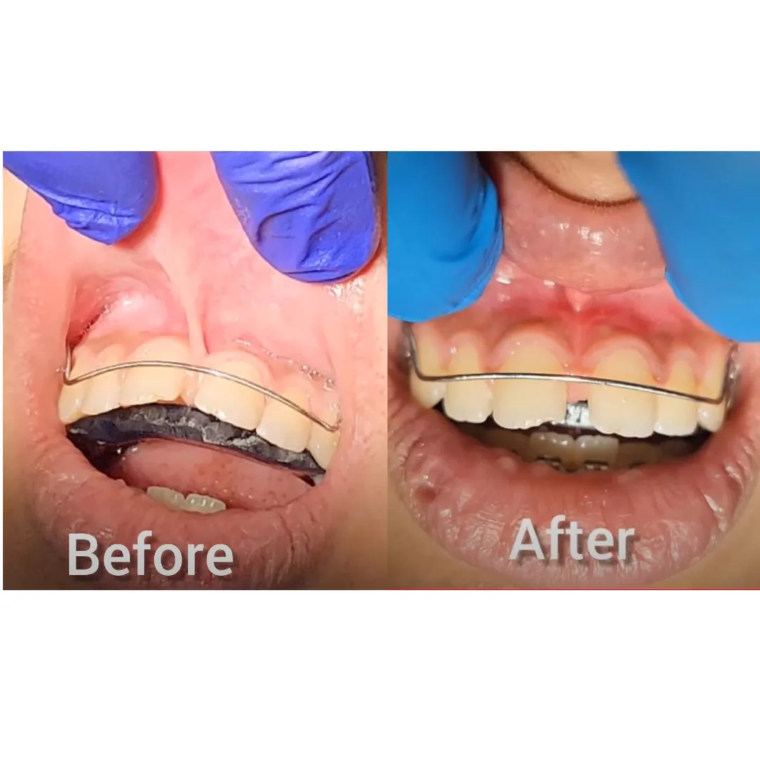 Laser Frenectomy