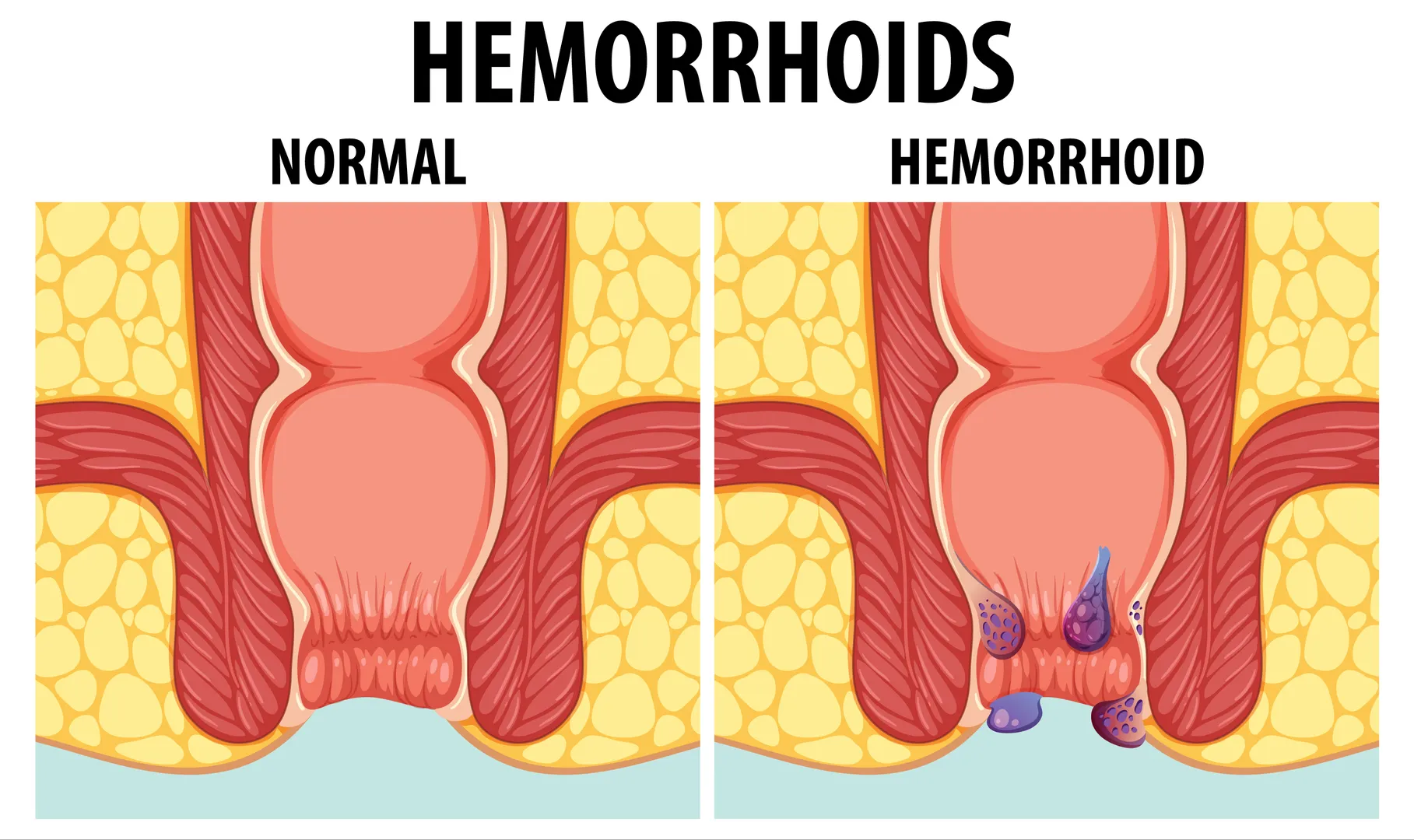 Laser Ablation of Hemorrhoids in Mahalaxmi – A Painless Treatment for Piles