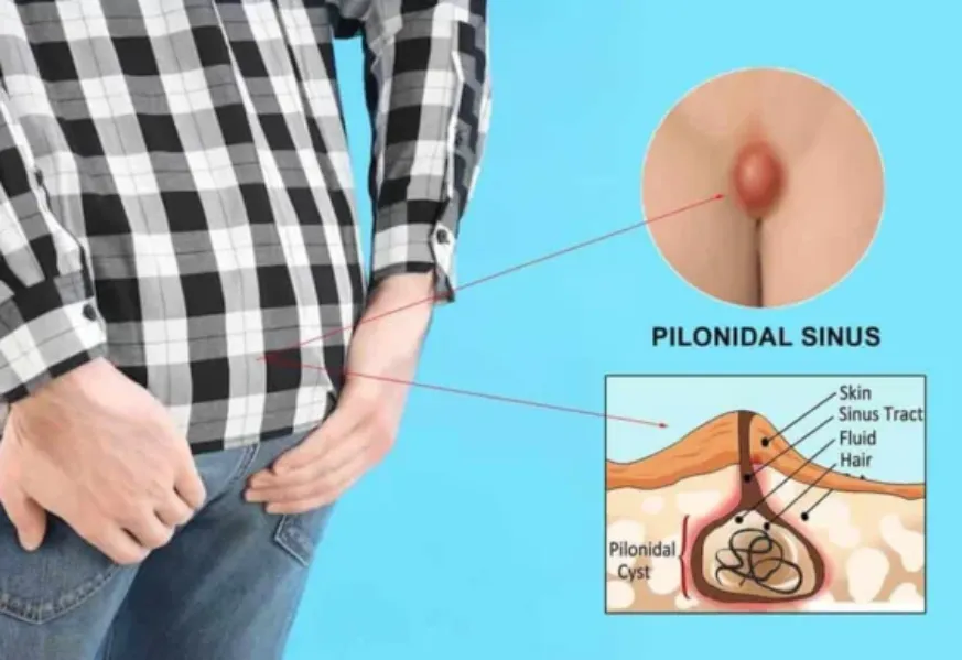 Laser Ablation of Pilonidal Sinus in Grant Road – A Fast and Effective Solution