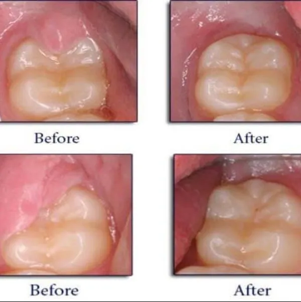 Best operculectomy Treatment In Ghansoli