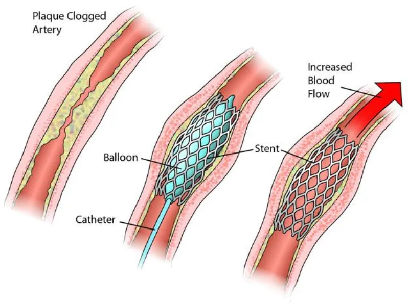 Angioplasty in Pune
