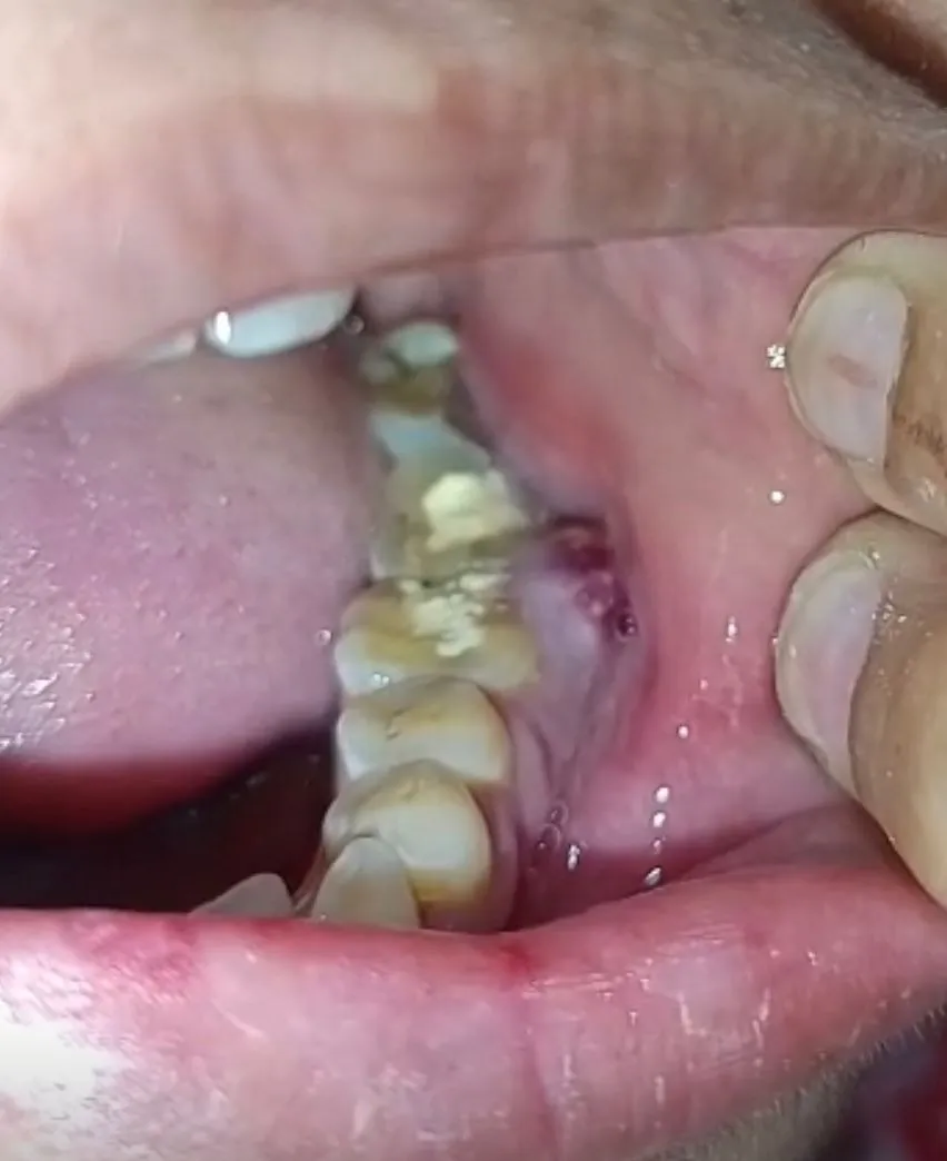 Can Root Canal Be Done If There Is Swelling?