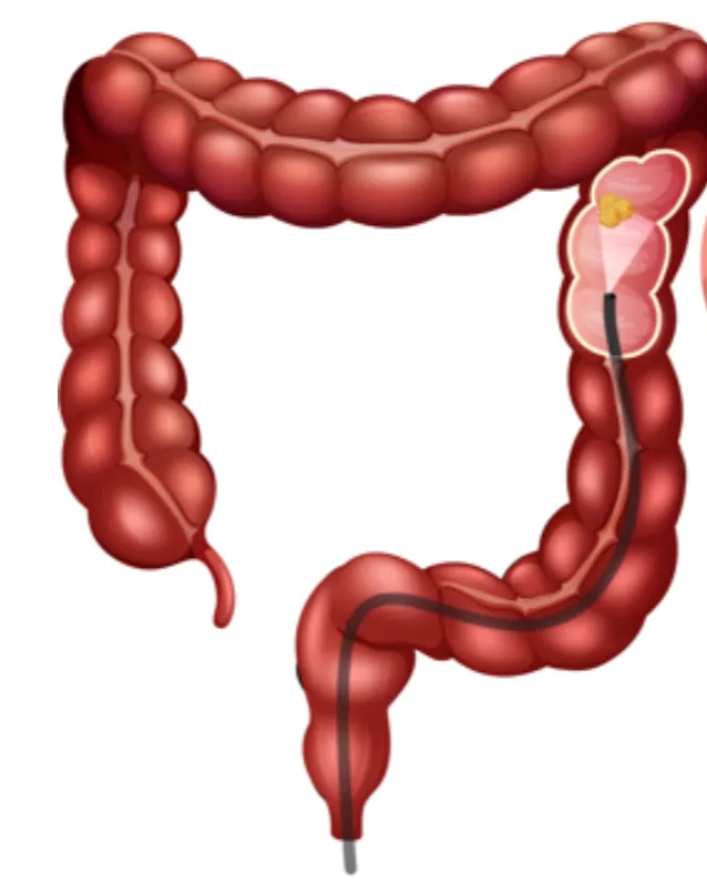 Colonic Polyps in Mumbai | Early Detection and Polyp Removal