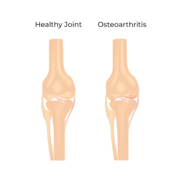 Osteoarthritis Care in Noida Supporting Joint Comfort and Movement