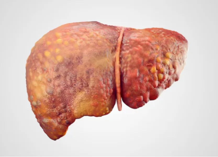 Fatty Liver in Mumbai