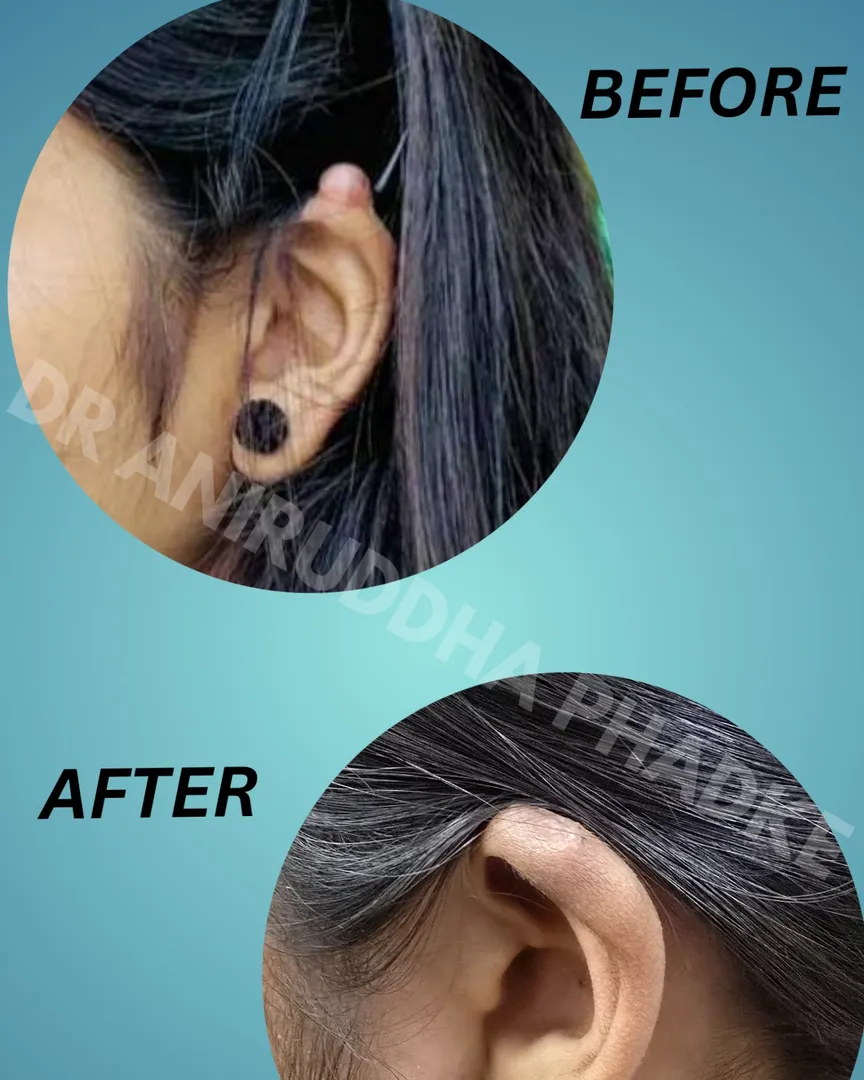 Ear Keloid Surgery