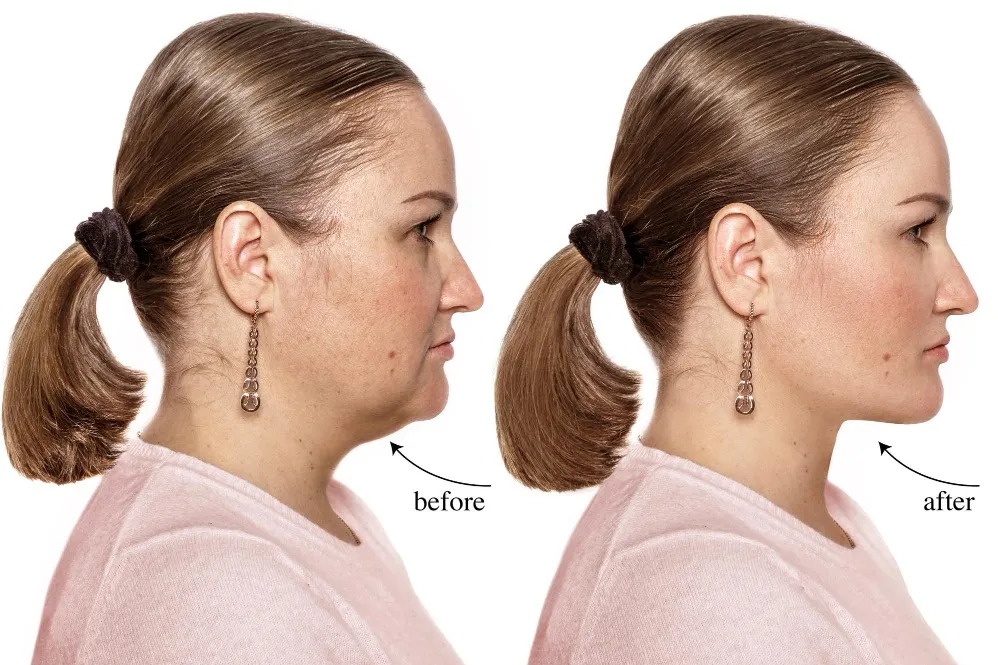 Fat Grafting in Bangalore – Restore Volume with Natural Tissue