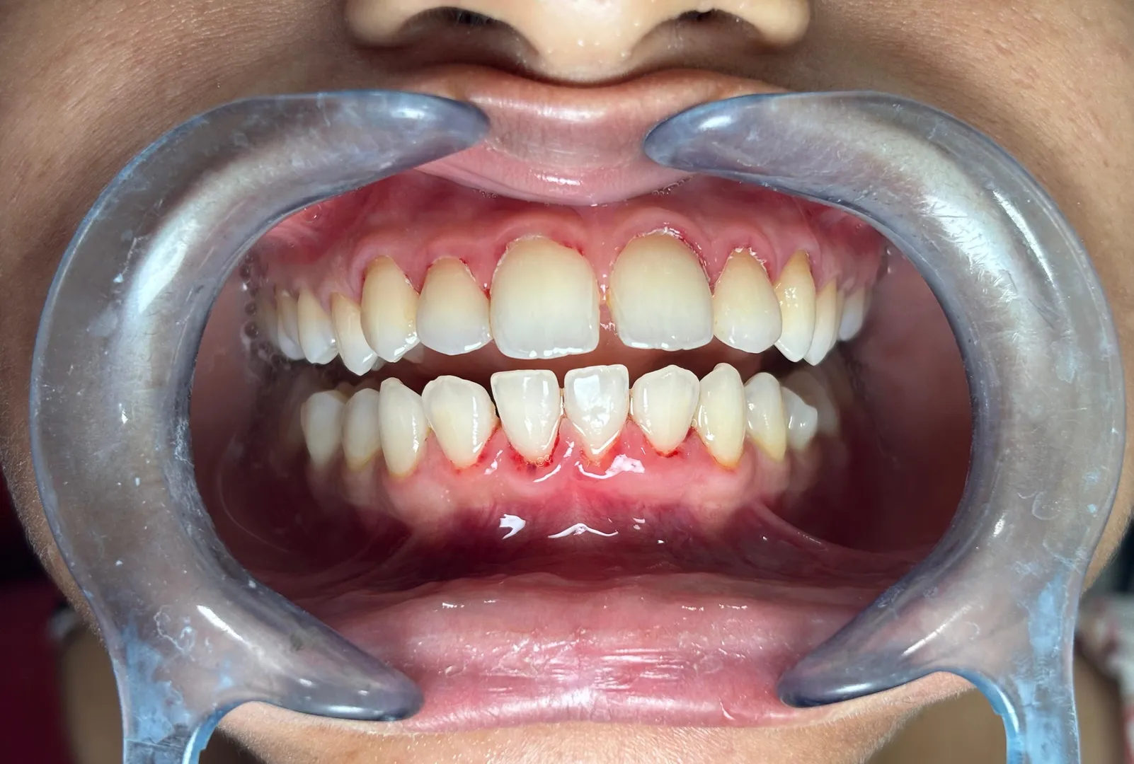 Gaps Between Teeth – Can They Be Closed Without Braces?