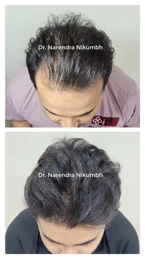 Life Changing Hair Transplant Surgery in Thane.Many people ask is Hair Transplant even worth doing ?...