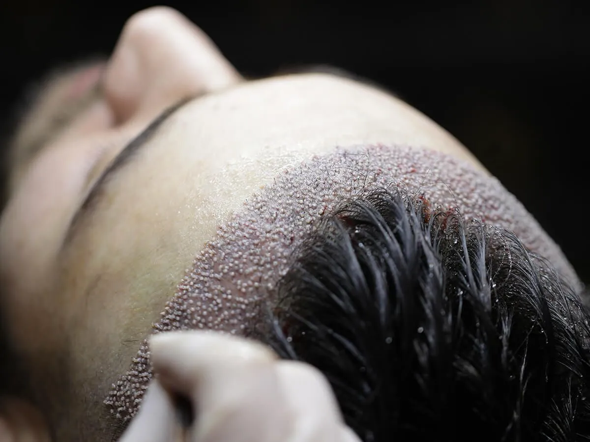 best hair implant doctor in nashik
affordable hair transplant clinic in n
hair restoration in nashik