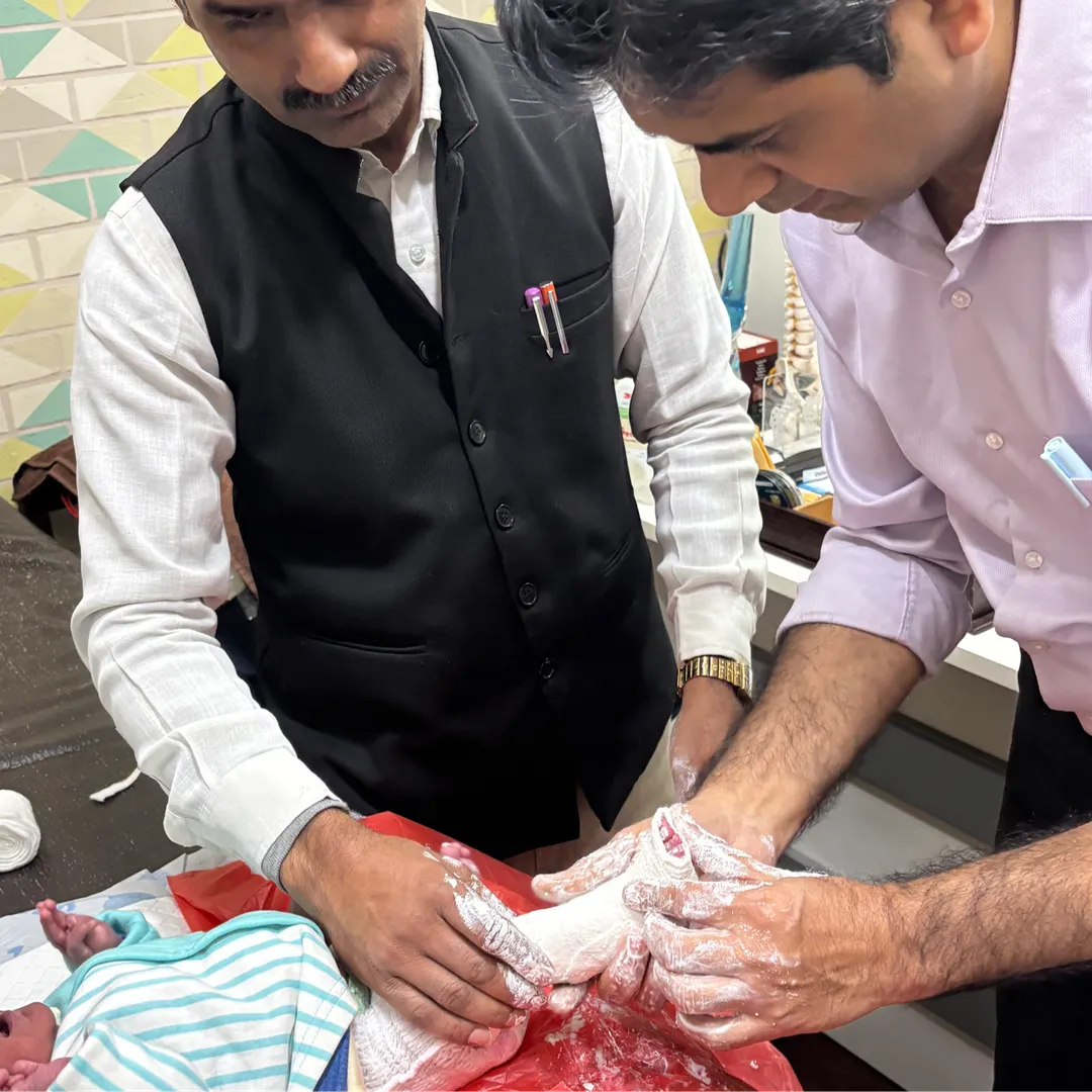 CTEV (club foot) cast applied at Dr Pankaj Ortho Centre